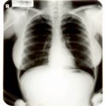 Zdjęcie RTG klatki piersiowej Marilyn Monroe, cs 45 000 dolarów (za trzy sztuki).