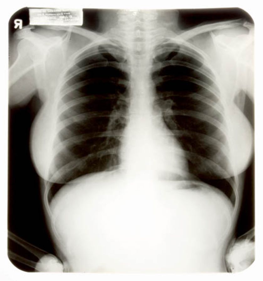 Zdjęcie RTG klatki piersiowej Marilyn Monroe, cs 45 000 dolarów (za trzy sztuki).